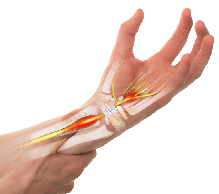 carpal tunnel syndrome