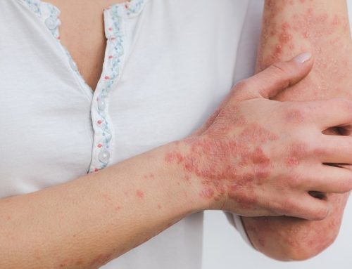 Studies Show Chinese Medicine Safe and Effective for the Treatment of Psoriasis