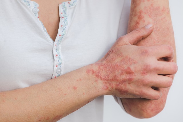 Studies show Chinese Medicine safe and effective for the treatment of psoriasis